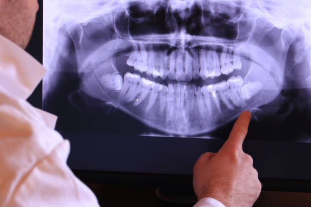 Best Emergency Wisdom Teeth Removal in Coal City, IL